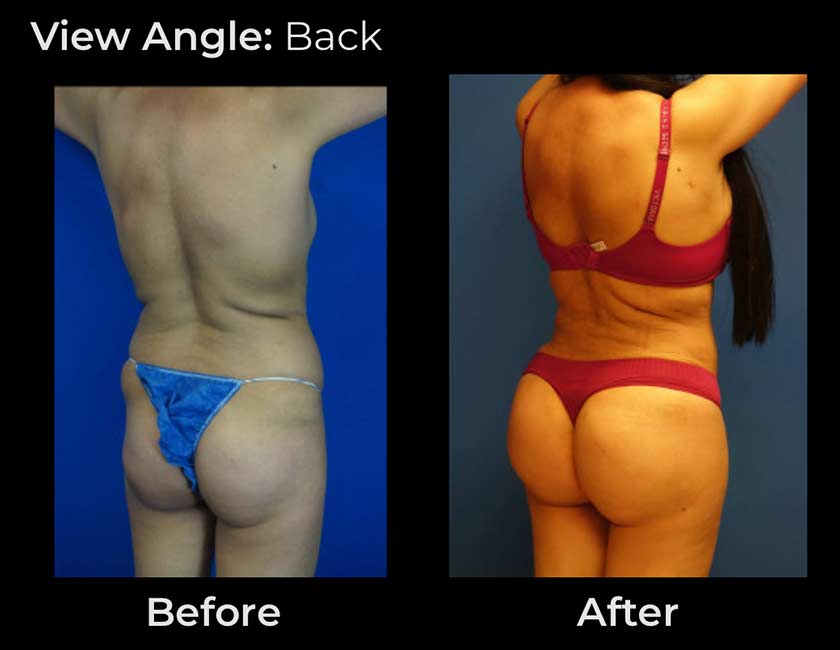 Before and After Brazilian Butt Lift ( Fat Transfer or Liquid) at Face Works Plastic Surgery, Plastic Surgeon Near Me in Schaumburg, IL