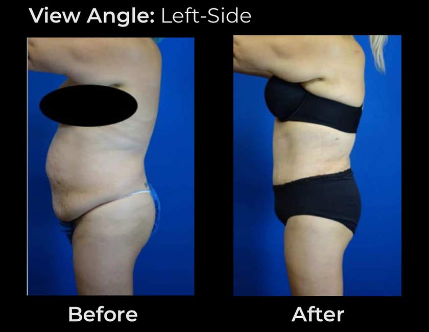 Before and After Tummy Tuck at Face Works Plastic Surgery, Plastic Surgeon Near Me in Schaumburg, IL