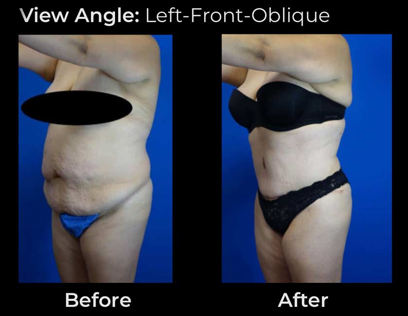 Before and After Tummy Tuck at Face Works Plastic Surgery, Plastic Surgeon Near Me in Schaumburg, IL