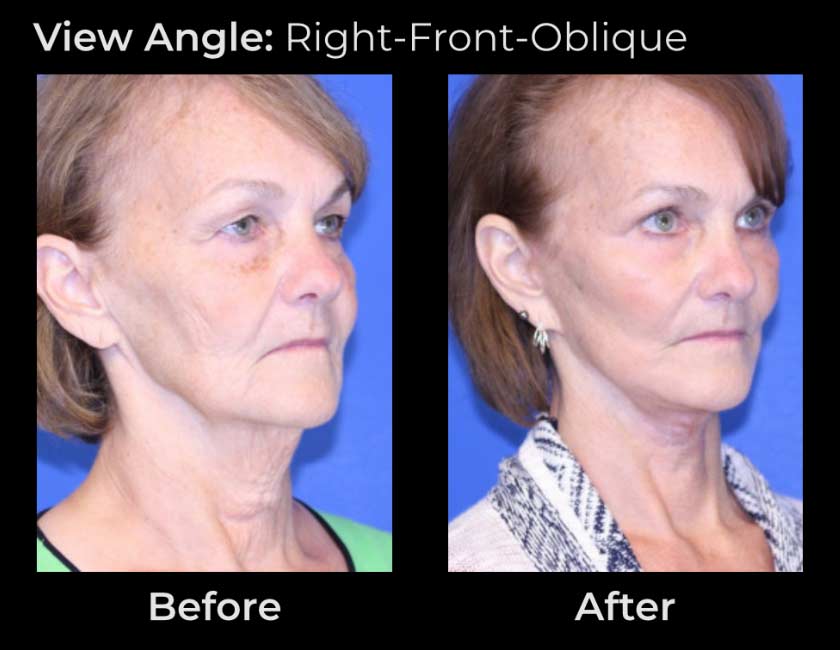 Before and After Face & Neck Lift at Face Works Plastic Surgery Near Me in Schaumburg, IL
