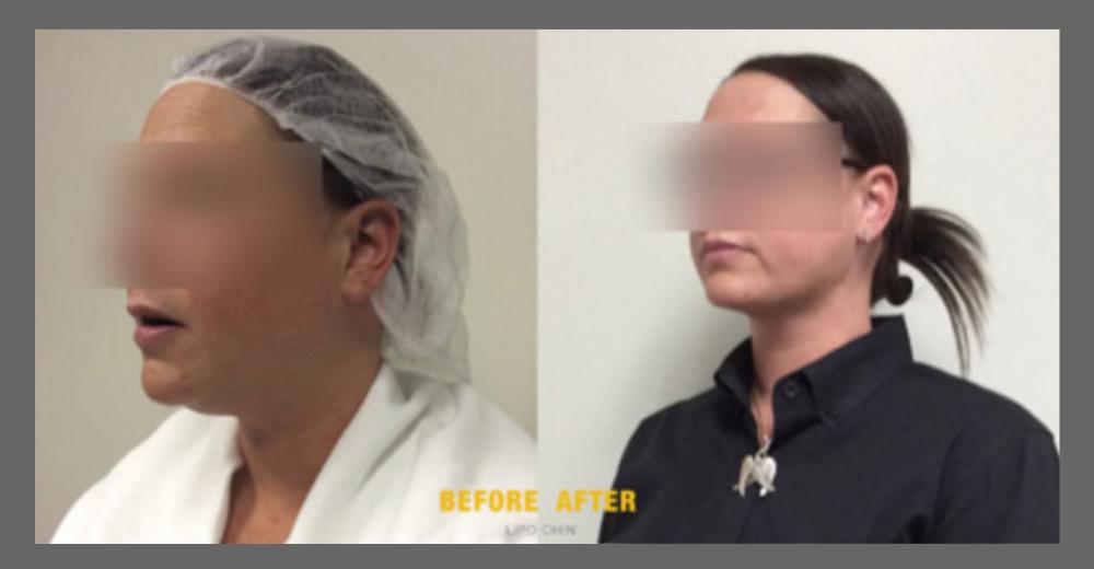 Before and After HD LipoX® of Jawline at Face Works Plastic Surgery, Plastic Surgeon Near Me in Schaumburg, IL