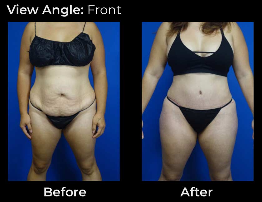 Before and After Tummy Tuck at Face Works Plastic Surgery, Plastic Surgeon Near Me in Schaumburg, IL