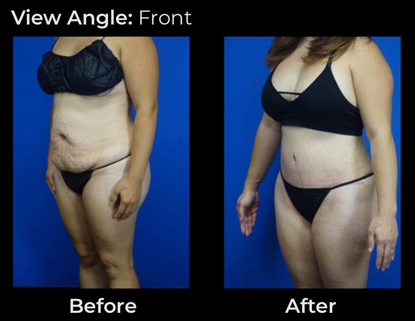 Before and After Tummy Tuck at Face Works Plastic Surgery, Plastic Surgeon Near Me in Schaumburg, IL