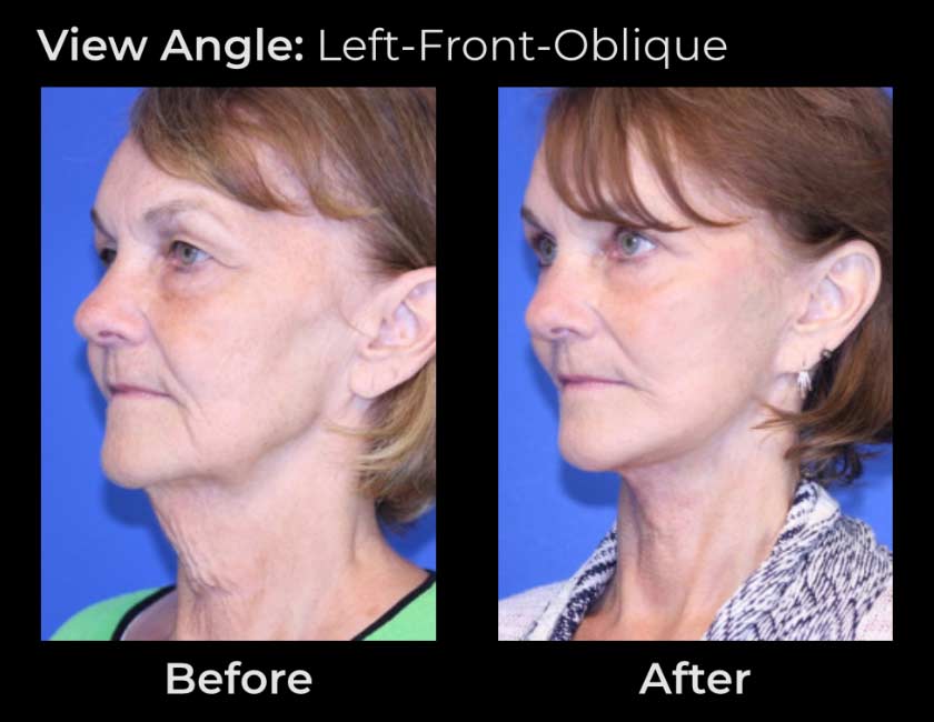 Before and After Face & Neck Lift at Face Works Plastic Surgery Near Me in Schaumburg, IL