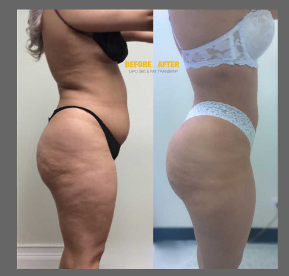 Before and After Brazilian Butt Lift ( Fat Transfer or Liquid) at Face Works Plastic Surgery, Plastic Surgeon Near Me in Schaumburg, IL