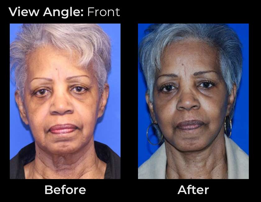 Before and After Face & Neck Lift at Face Works Plastic Surgery Near Me in Schaumburg, IL