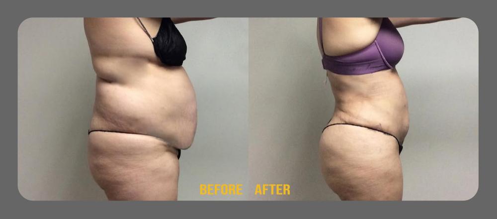 Before and After Tummy Tuck at Face Works Plastic Surgery, Plastic Surgeon Near Me in Schaumburg, IL