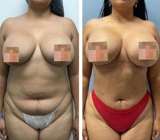 Before and After Body Liposuction at Face Works Plastic Surgery, Near Me in Schaumburg, IL
