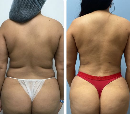 Before and After Body Liposuction at Face Works Plastic Surgery, Near Me in Schaumburg, IL