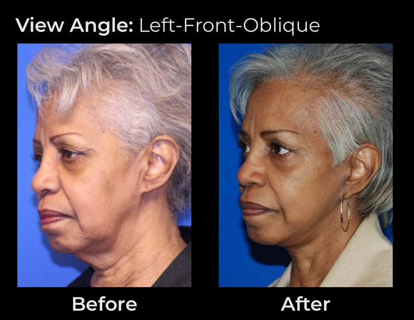 Before and After Face & Neck Lift at Face Works Plastic Surgery Near Me in Schaumburg, IL