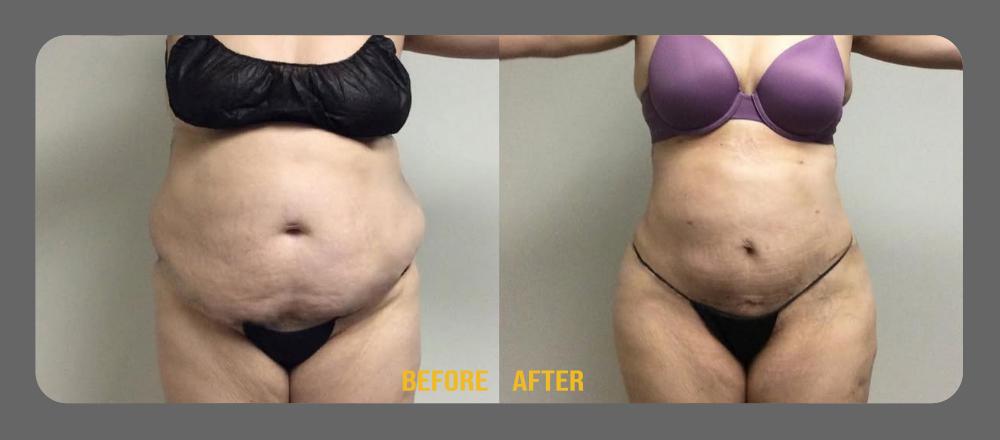 Before and After Tummy Tuck at Face Works Plastic Surgery, Plastic Surgeon Near Me in Schaumburg, IL