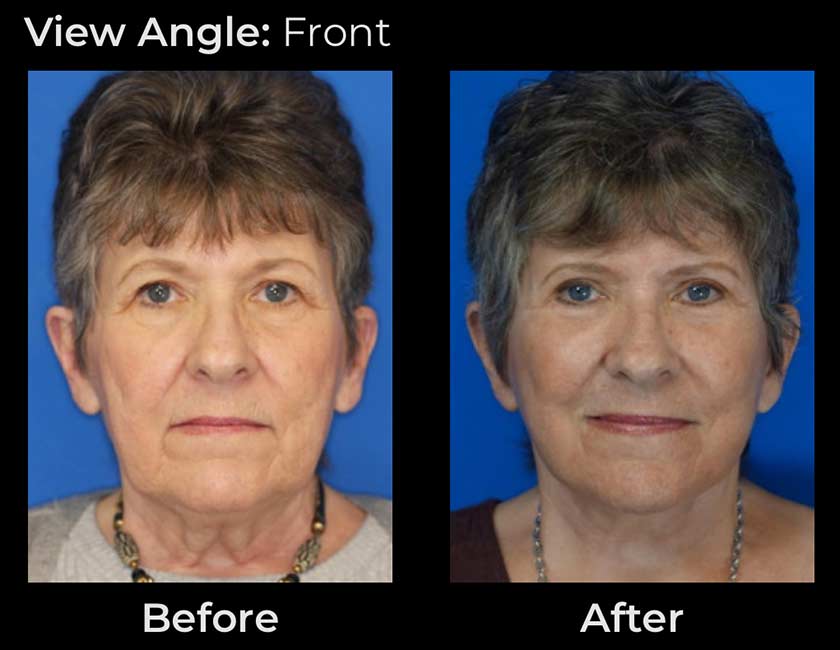 Before and After Face & Neck Lift at Face Works Plastic Surgery Near Me in Schaumburg, IL