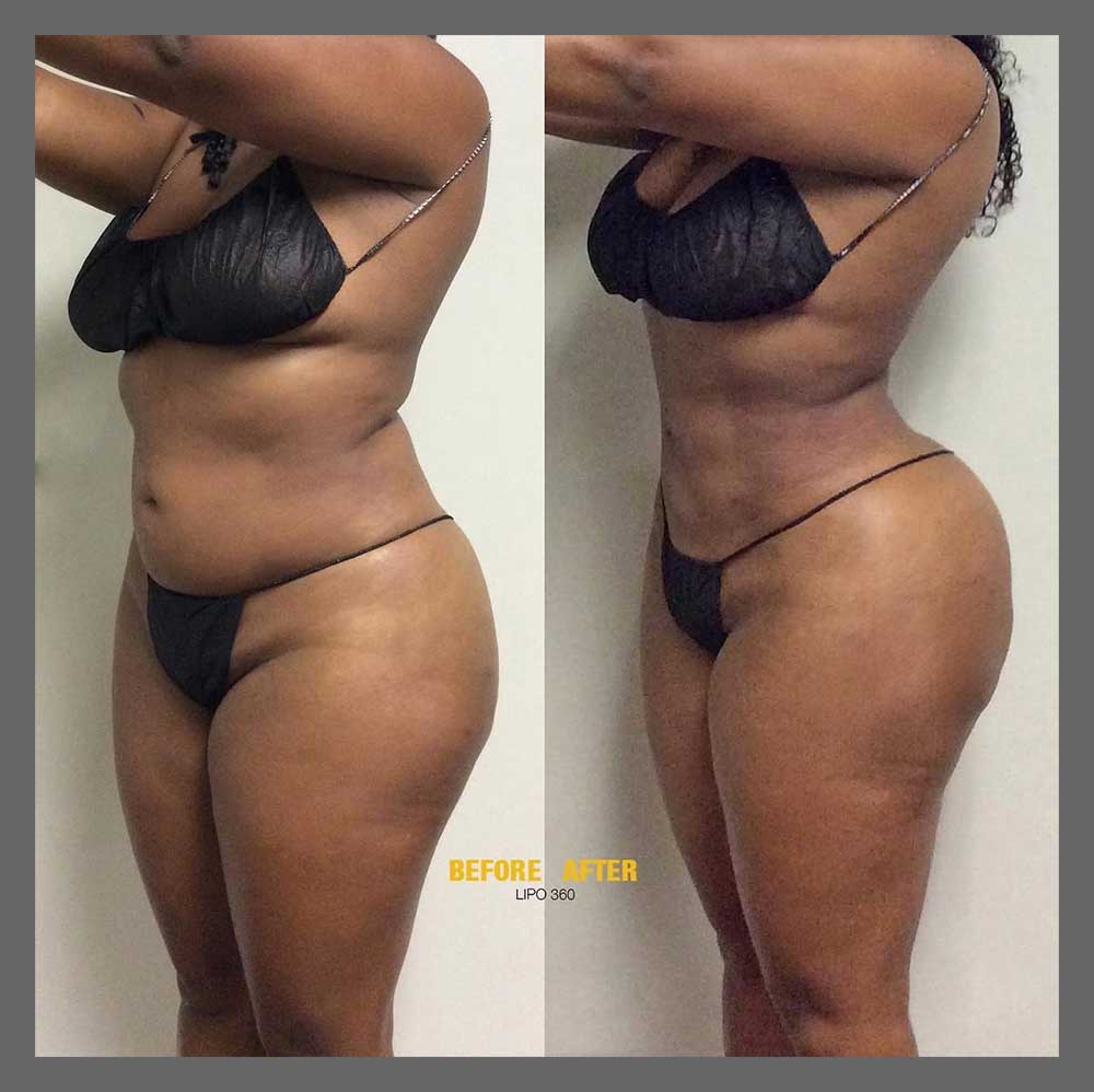Before and After Body Liposuction at Face Works Plastic Surgery, Near Me in Schaumburg, IL