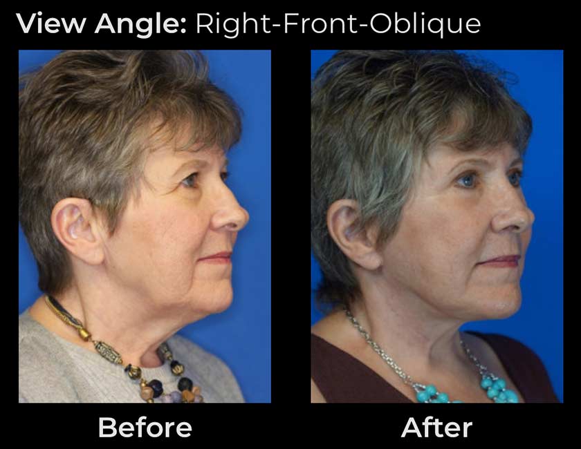 Before and After Face & Neck Lift at Face Works Plastic Surgery Near Me in Schaumburg, IL