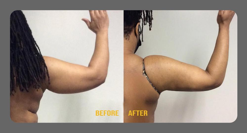 Before and After Arms Plastic Surgery at Face Works Plastic Surgery, Near Me in Schaumburg, IL