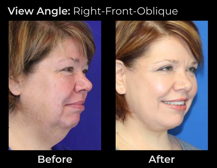 Before and After Face & Neck Lift at Face Works Plastic Surgery Near Me in Schaumburg, IL