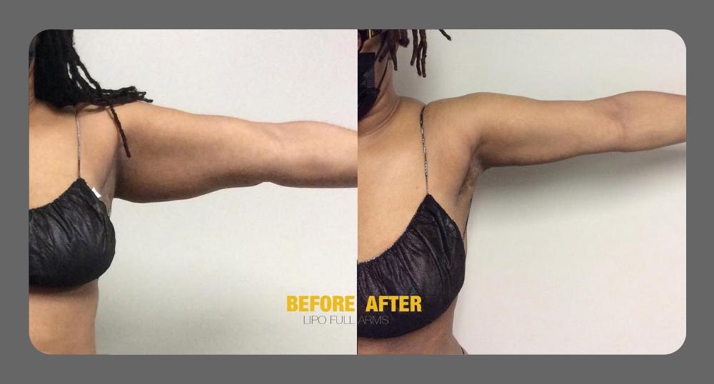 Before and After Arms Plastic Surgery at Face Works Plastic Surgery, Near Me in Schaumburg, IL