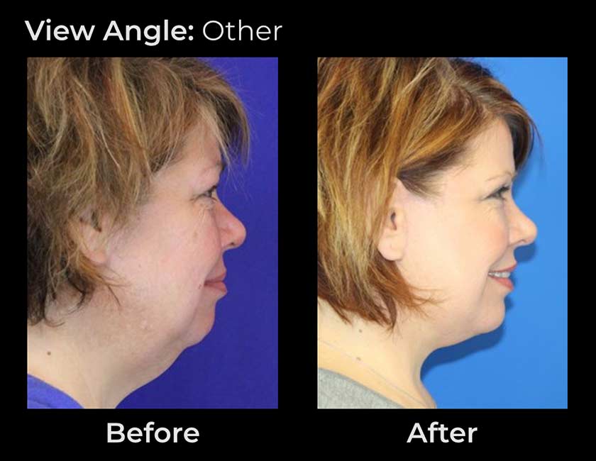 Before and After Face & Neck Lift at Face Works Plastic Surgery Near Me in Schaumburg, IL