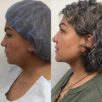 Before and After at Face Works Plastic Surgery, Plastic Surgeon in Schaumburg, IL