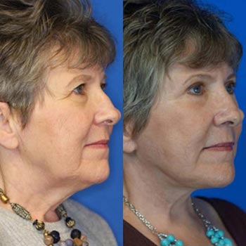 Before and After at Face Works Plastic Surgery, Plastic Surgeon in Schaumburg, IL