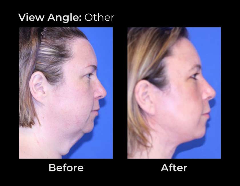 Before and After Face & Neck Lift at Face Works Plastic Surgery Near Me in Schaumburg, IL