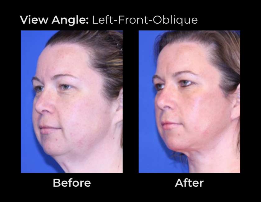 Before and After Face & Neck Lift at Face Works Plastic Surgery Near Me in Schaumburg, IL