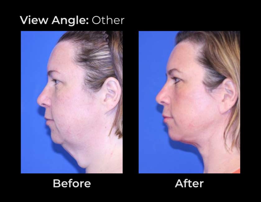 Before and After Face & Neck Lift at Face Works Plastic Surgery Near Me in Schaumburg, IL