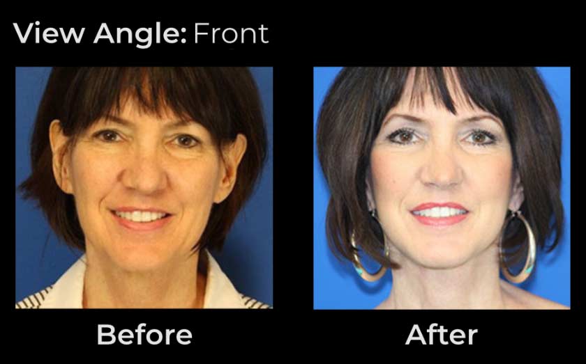 Before and After Face & Neck Lift at Face Works Plastic Surgery Near Me in Schaumburg, IL