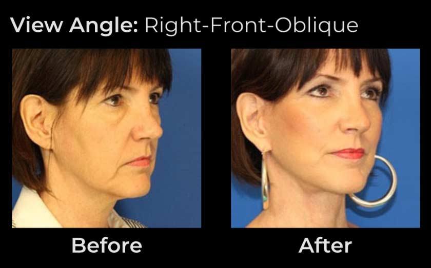 Before and After Face & Neck Lift at Face Works Plastic Surgery Near Me in Schaumburg, IL