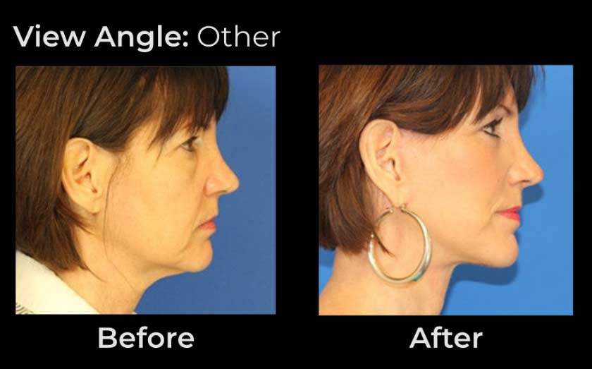 Before and After Face & Neck Lift at Face Works Plastic Surgery Near Me in Schaumburg, IL