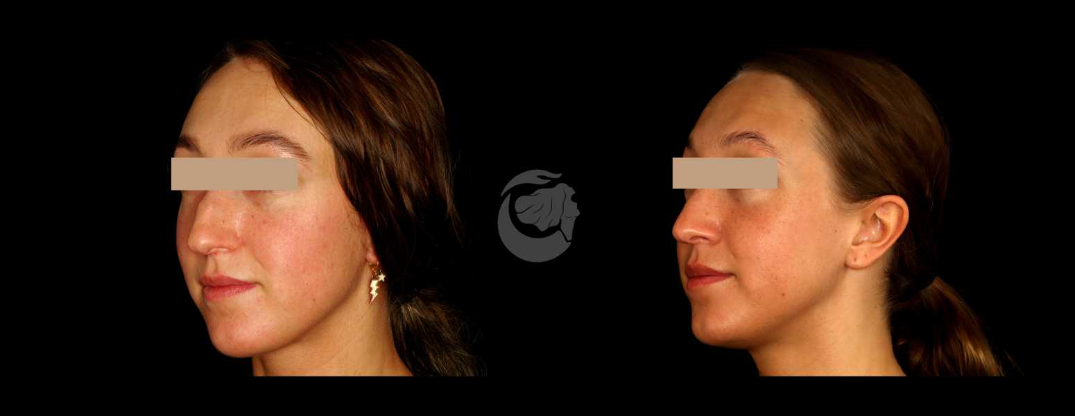 Before and After Nose Plastic Surgery at Face Works Plastic Surgery, Near Me in Schaumburg, IL