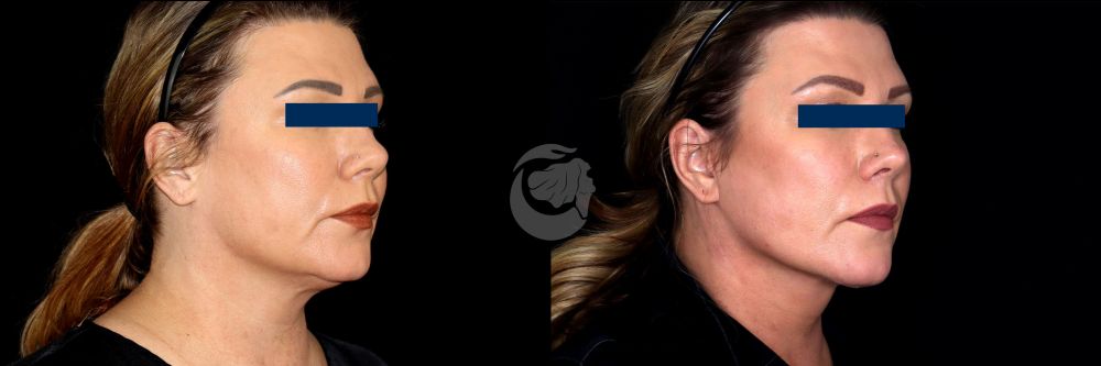 Before and After Face & Neck Lift at Face Works Plastic Surgery Near Me in Schaumburg, IL