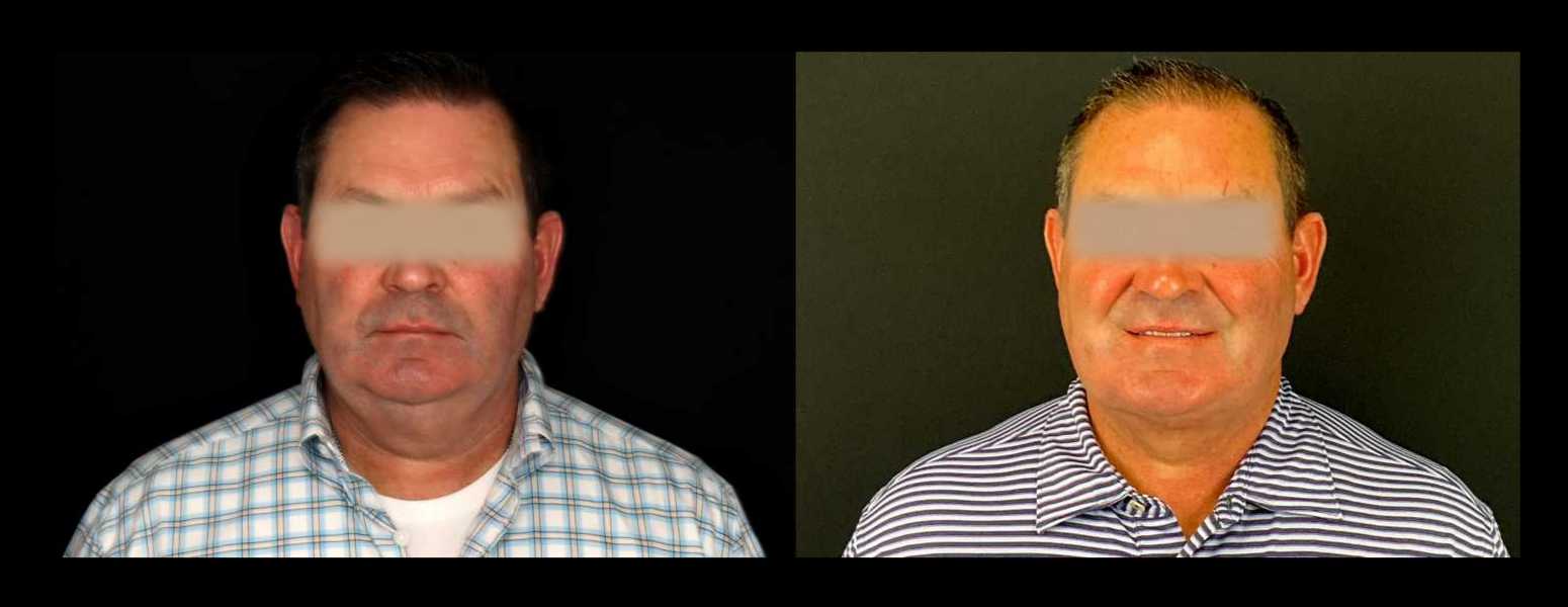 Before and After HD LipoX® of Jawline at Face Works Plastic Surgery, Plastic Surgeon Near Me in Schaumburg, IL