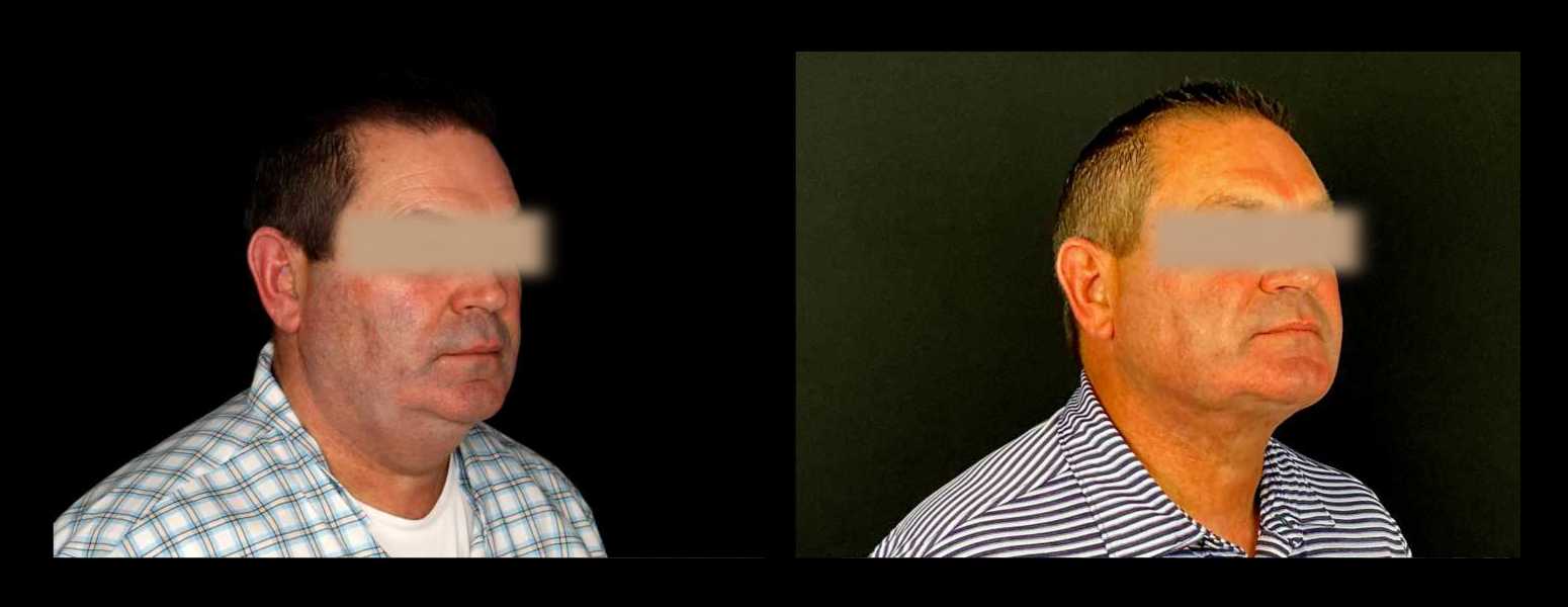 Before and After HD LipoX® of Jawline at Face Works Plastic Surgery, Plastic Surgeon Near Me in Schaumburg, IL