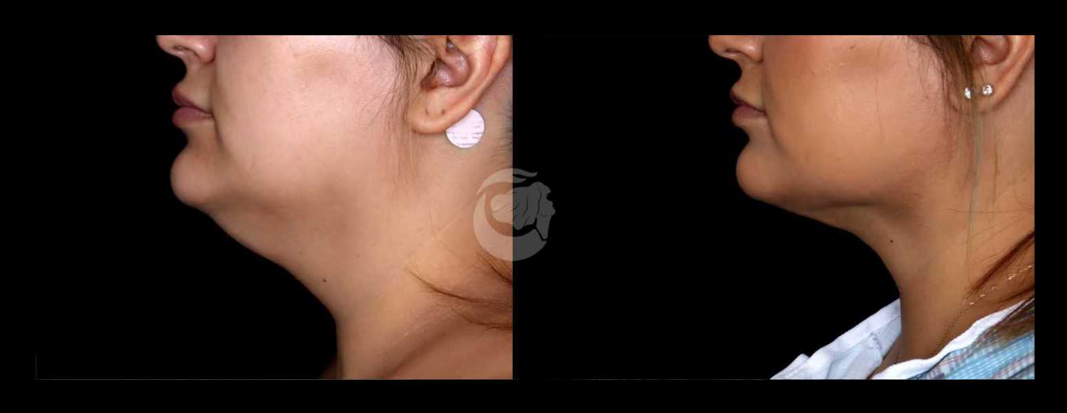 Before and After HD LipoX® of Jawline at Face Works Plastic Surgery, Plastic Surgeon Near Me in Schaumburg, IL