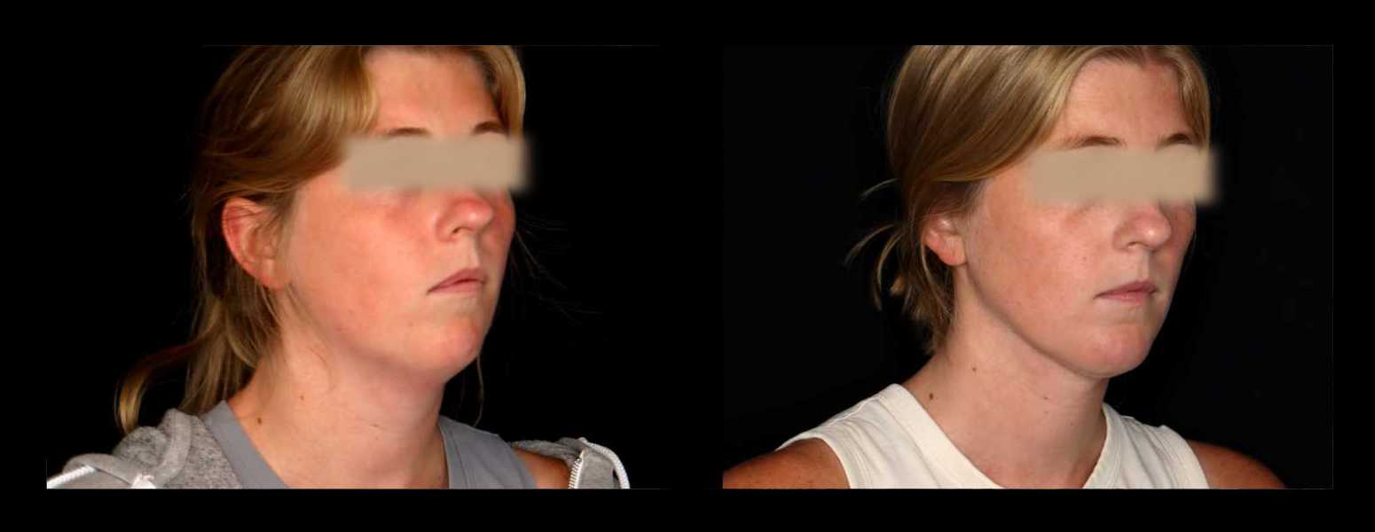 Before and After HD LipoX® of Jawline at Face Works Plastic Surgery, Plastic Surgeon Near Me in Schaumburg, IL