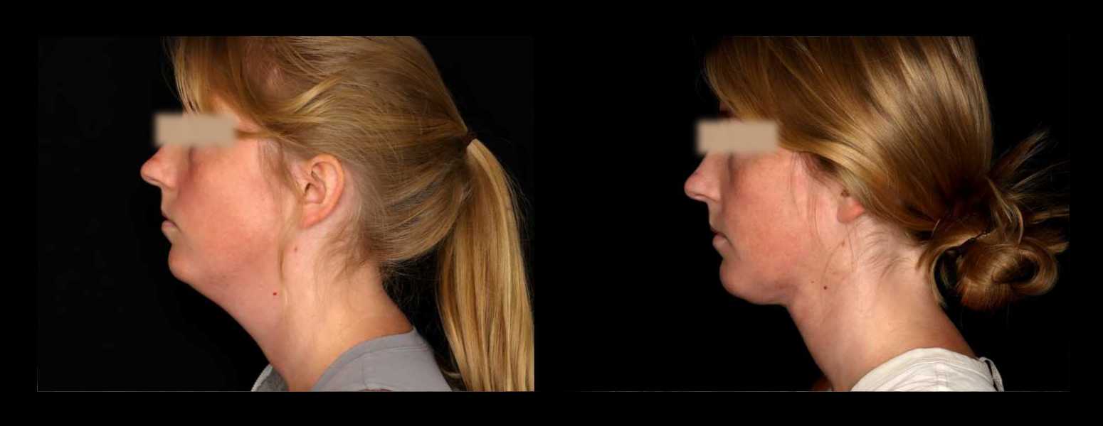 Before and After HD LipoX® of Jawline at Face Works Plastic Surgery, Plastic Surgeon Near Me in Schaumburg, IL