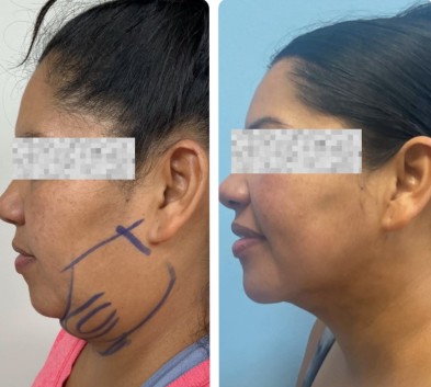 Before and After HD LipoX® of Jawline at Face Works Plastic Surgery, Plastic Surgeon Near Me in Schaumburg, IL