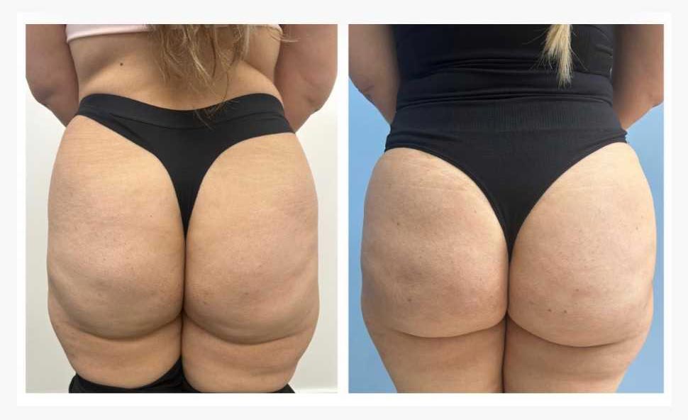 Before and After Liquid Butt Lift at Face Works Plastic Surgery, Plastic Surgeon Near Me in Schaumburg, IL