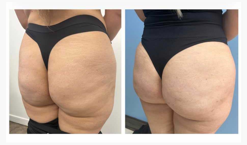 Before and After Liquid Butt Lift at Face Works Plastic Surgery, Plastic Surgeon Near Me in Schaumburg, IL