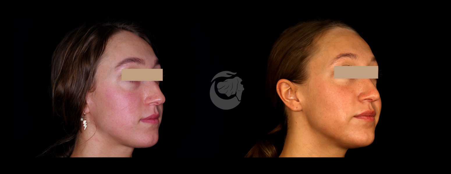 Before and After Nose Plastic Surgery at Face Works Plastic Surgery, Near Me in Schaumburg, IL