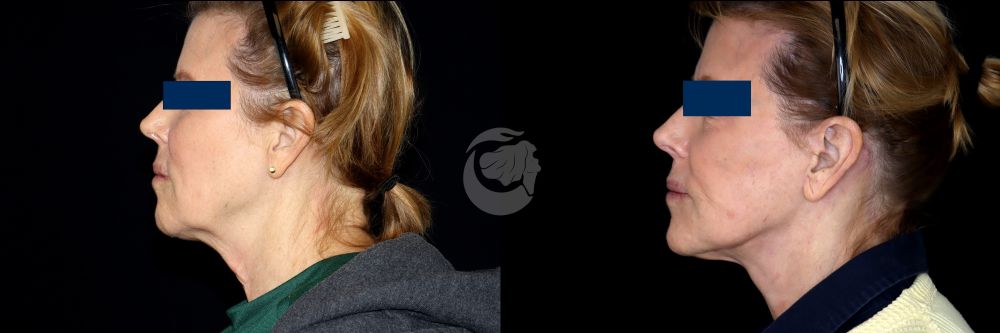 Before and After Face & Neck Lift at Face Works Plastic Surgery Near Me in Schaumburg, IL