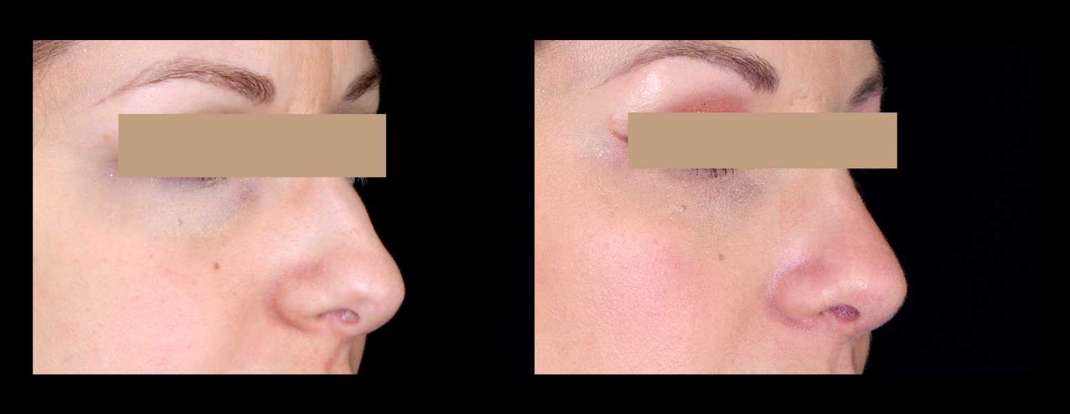 Before and After Nose Plastic Surgery at Face Works Plastic Surgery, Near Me in Schaumburg, IL