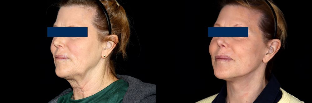 Before and After Face & Neck Lift at Face Works Plastic Surgery Near Me in Schaumburg, IL