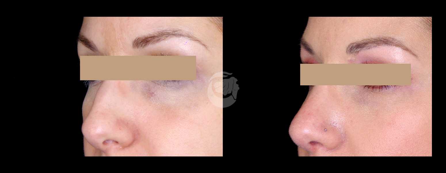 Before and After Nose Plastic Surgery at Face Works Plastic Surgery, Near Me in Schaumburg, IL