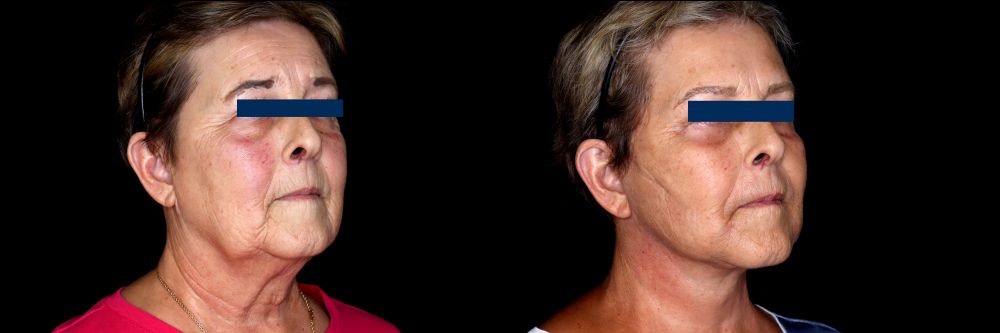 Before and After Face & Neck Lift at Face Works Plastic Surgery Near Me in Schaumburg, IL