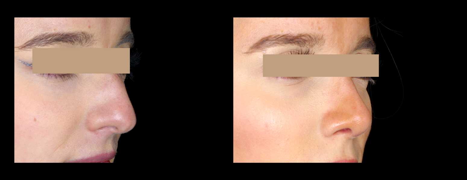 Before and After Nose Plastic Surgery at Face Works Plastic Surgery, Near Me in Schaumburg, IL