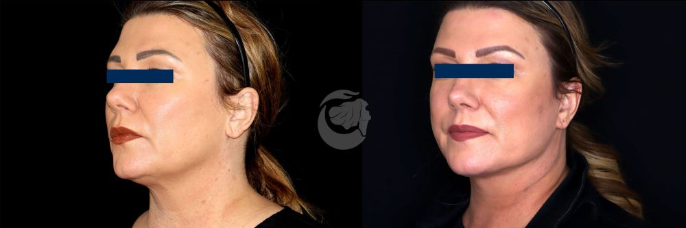 Before and After Face & Neck Lift at Face Works Plastic Surgery Near Me in Schaumburg, IL