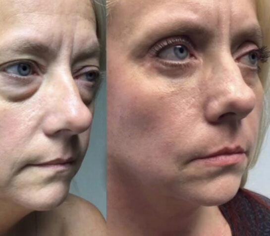 Before and After Eyelids Plastic Surgery at Face Works Plastic Surgery, Near Me in Schaumburg, IL