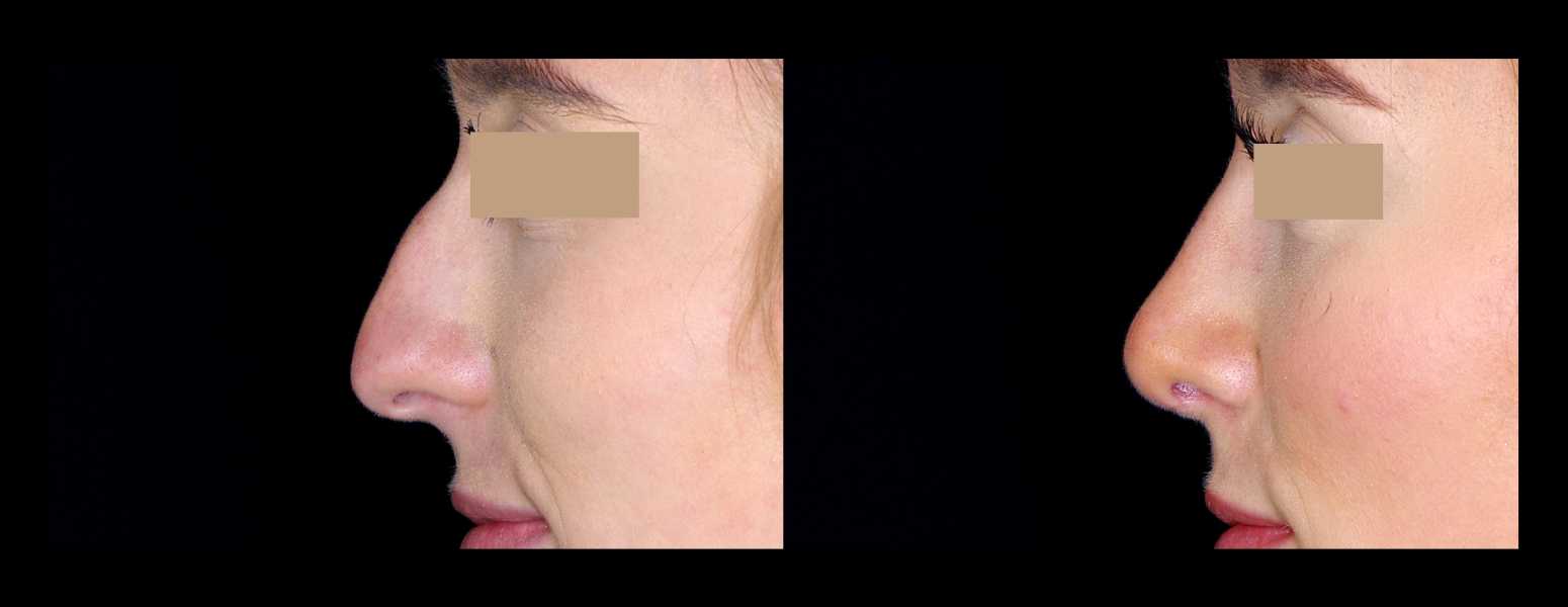 Before and After Nose Plastic Surgery at Face Works Plastic Surgery, Near Me in Schaumburg, IL